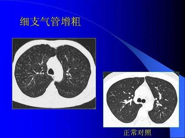 肺内基本病变的MSCT观察与分析