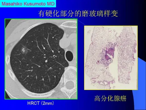 肺内基本病变的MSCT观察与分析