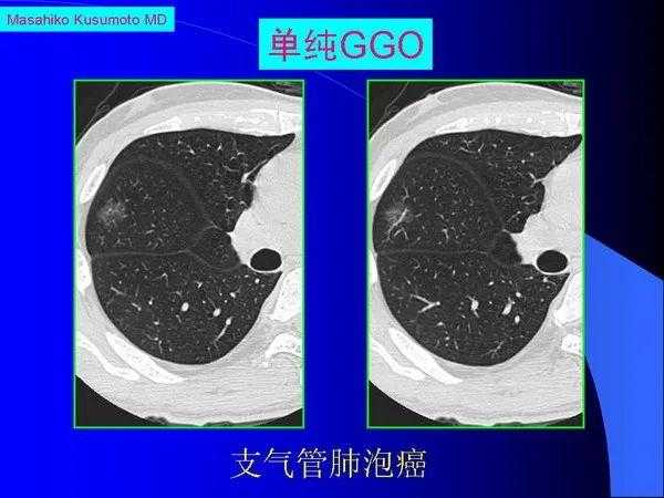 肺内基本病变的MSCT观察与分析