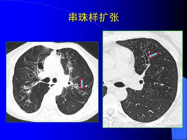 肺内基本病变的MSCT观察与分析