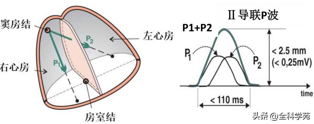 心电图理论笔记15： 窦性P波：正常与异常