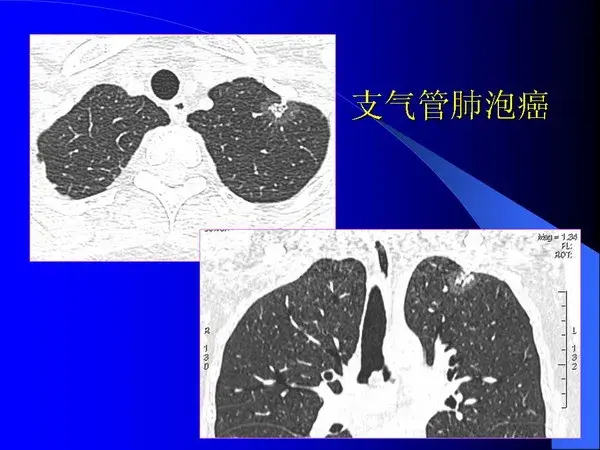 肺内基本病变的MSCT观察与分析