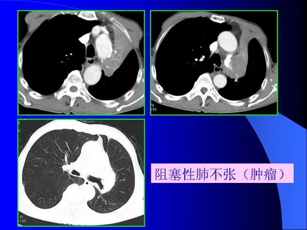 肺内基本病变的MSCT观察与分析