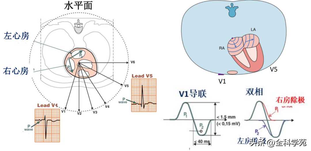 心电图理论笔记15： 窦性P波：正常与异常