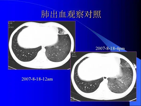 肺内基本病变的MSCT观察与分析