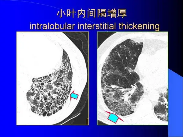 肺内基本病变的MSCT观察与分析