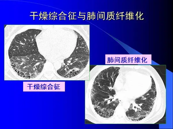 肺内基本病变的MSCT观察与分析