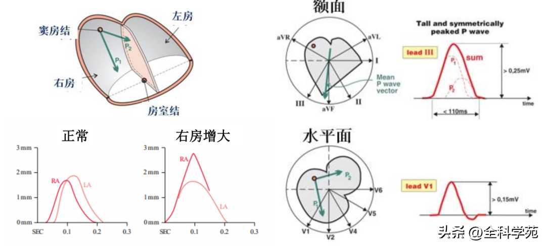 心电图理论笔记15： 窦性P波：正常与异常