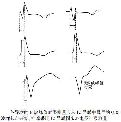 新版《心电图测量技术指南》，心内科医生都在转！