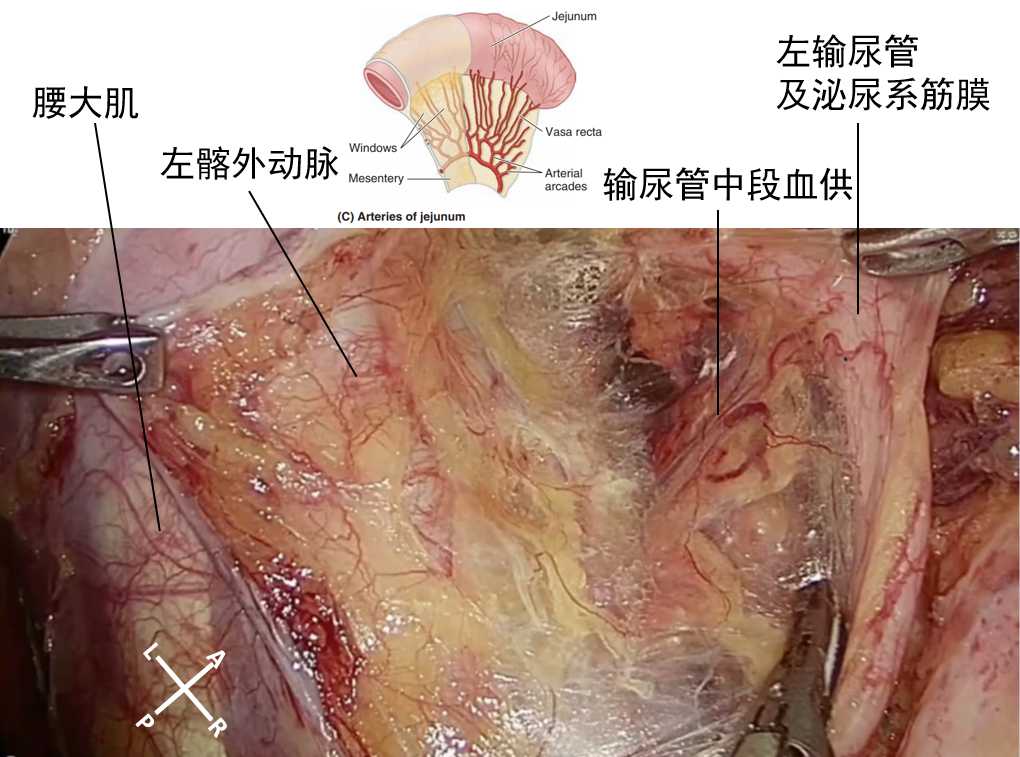 腹盆腔筋膜间层面解剖