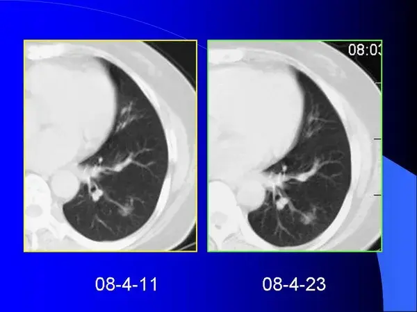 肺内基本病变的MSCT观察与分析