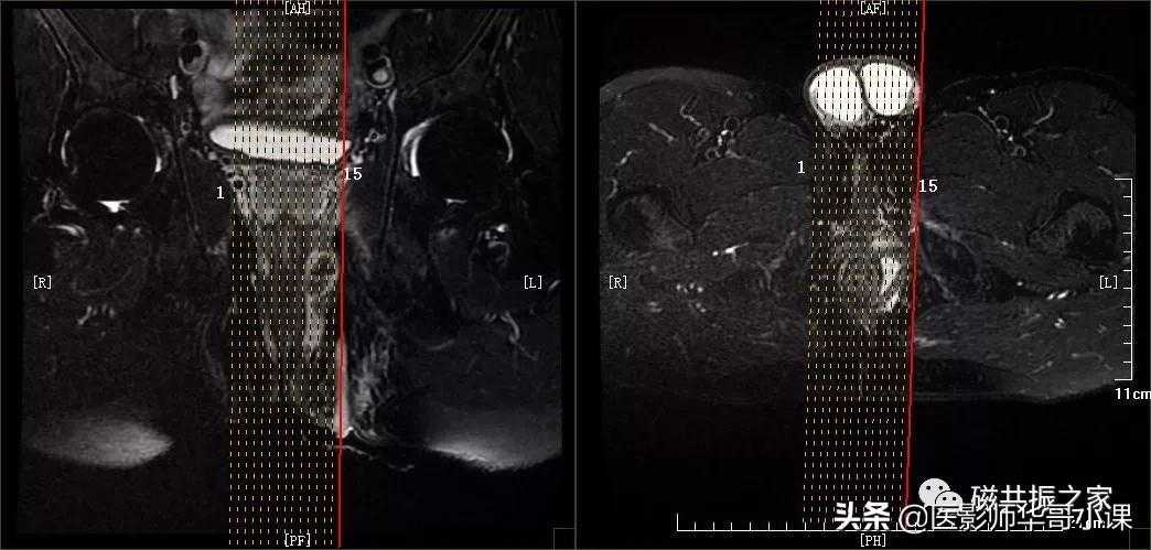 磁共振直肠MRI及肛周MRI扫描技术