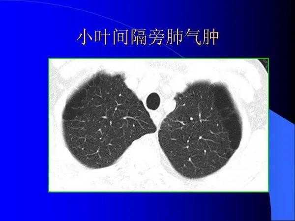 肺内基本病变的MSCT观察与分析