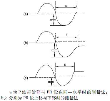 新版《心电图测量技术指南》，心内科医生都在转！