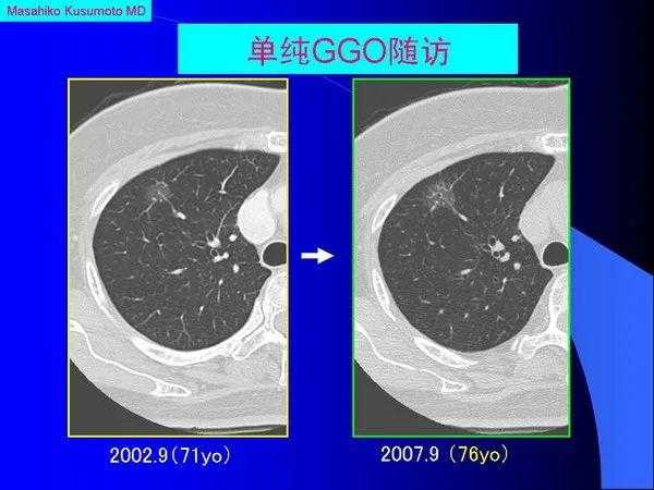 肺内基本病变的MSCT观察与分析