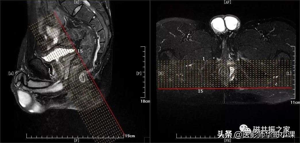 磁共振直肠MRI及肛周MRI扫描技术