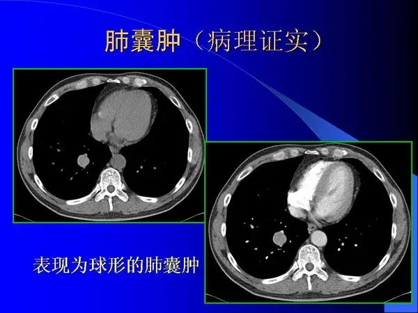 肺内基本病变的MSCT观察与分析