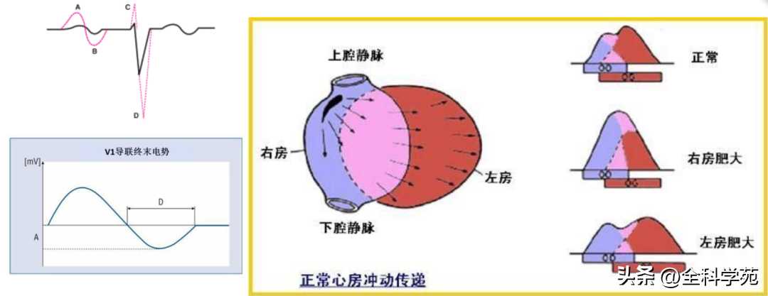 心电图理论笔记15： 窦性P波：正常与异常