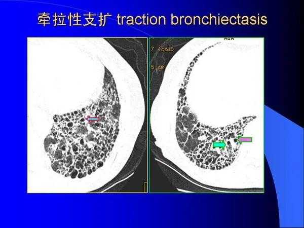 肺内基本病变的MSCT观察与分析