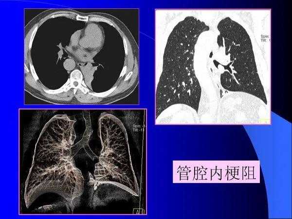 肺内基本病变的MSCT观察与分析