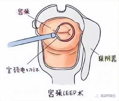 宫颈锥切术——宫颈冷刀锥切(CKC)与宫颈电环切术（LEEP）的区别
