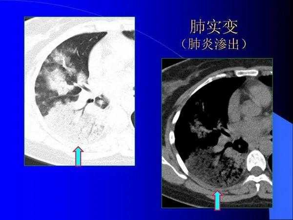 肺内基本病变的MSCT观察与分析