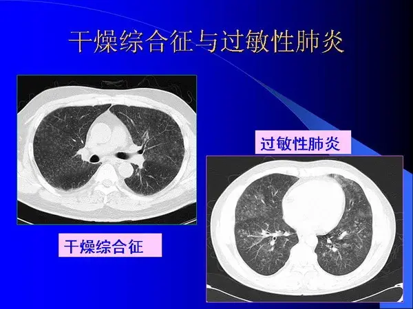 肺内基本病变的MSCT观察与分析