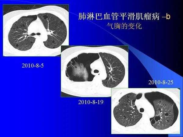 肺内基本病变的MSCT观察与分析