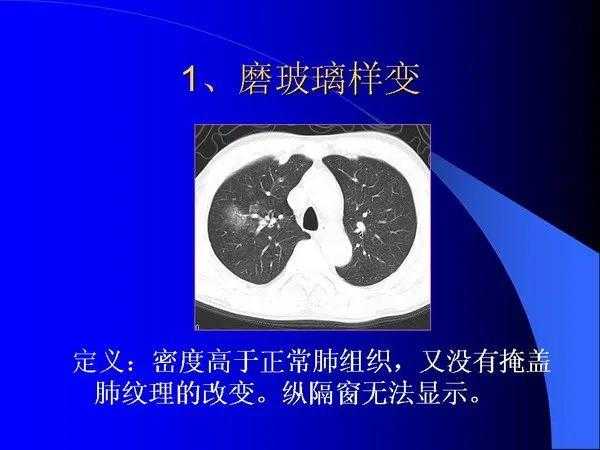 肺内基本病变的MSCT观察与分析