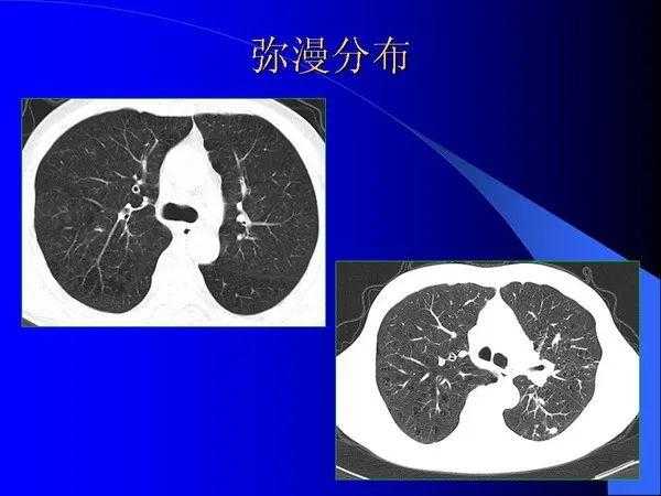 肺内基本病变的MSCT观察与分析